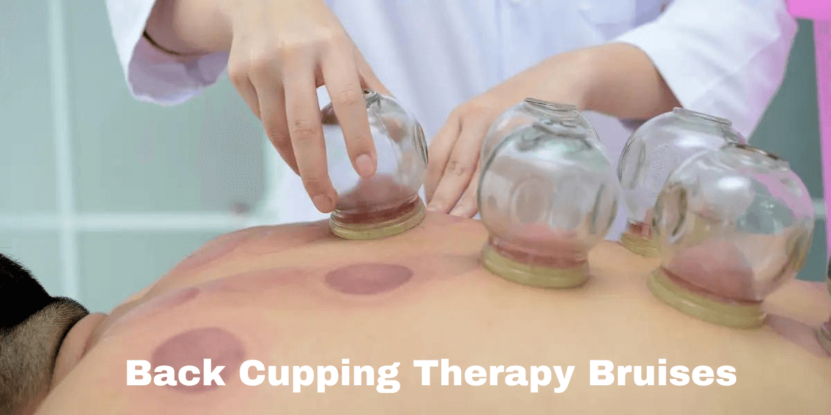 Cupping Bruises on back by chictmart